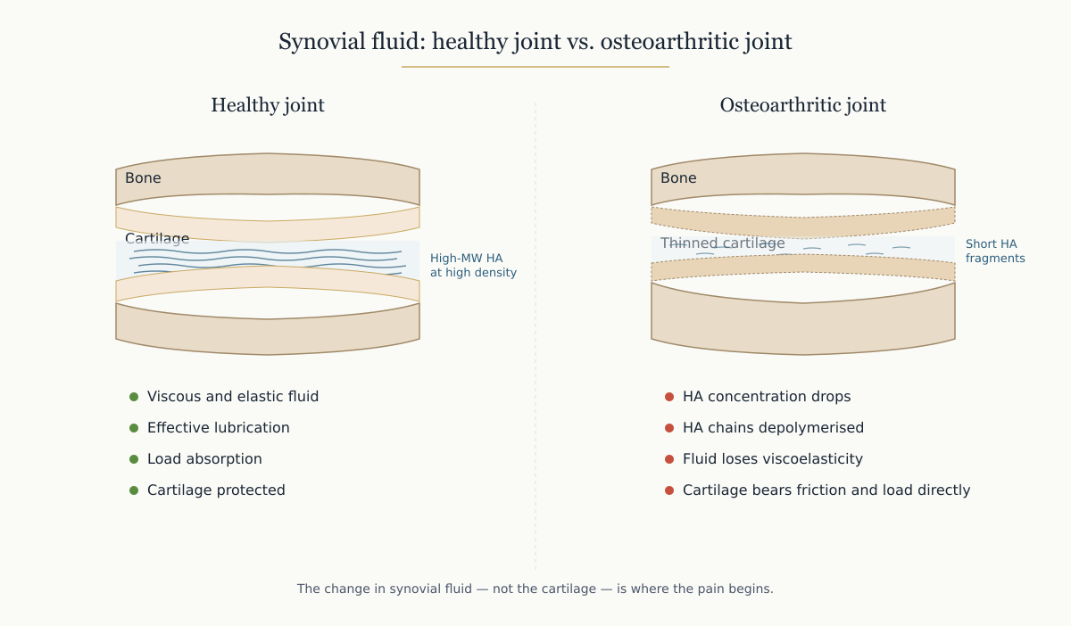 Next-Generation Intra-Articular Injections: synovial fluid mechanism in osteoarthritis